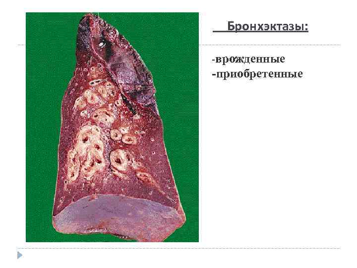 Бронхэктазы: -врожденные -приобретенные 