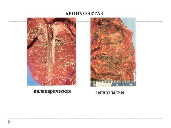 БРОНХОЭКТАЗ Ы цилиндрические мешотчатые 