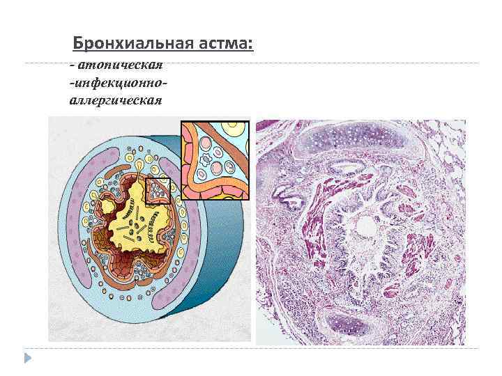 Бронхиальная астма: - атопическая -инфекционноаллергическая 