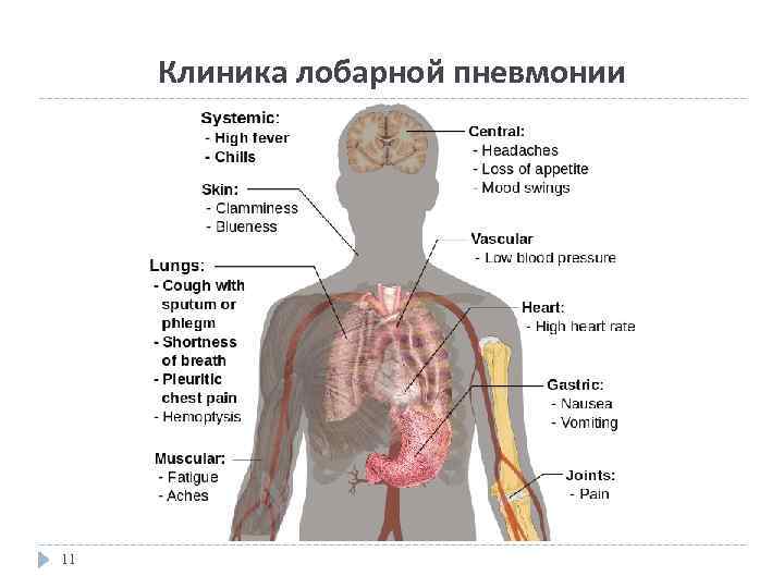 Клиника лобарной пневмонии 11 