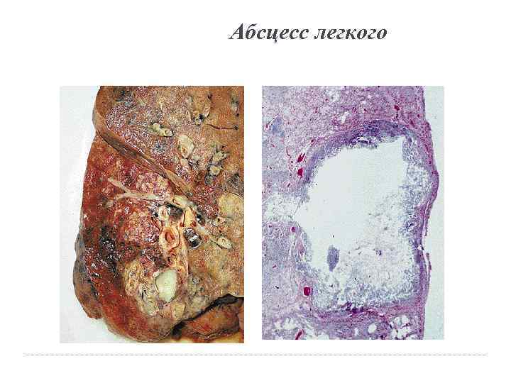 Абсцесс легкого 
