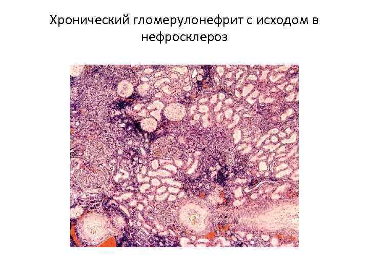 Артериолосклеротический нефросклероз микропрепарат рисунок
