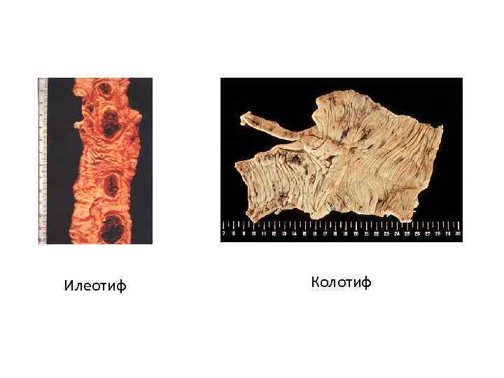 Илеотиф Колотиф 