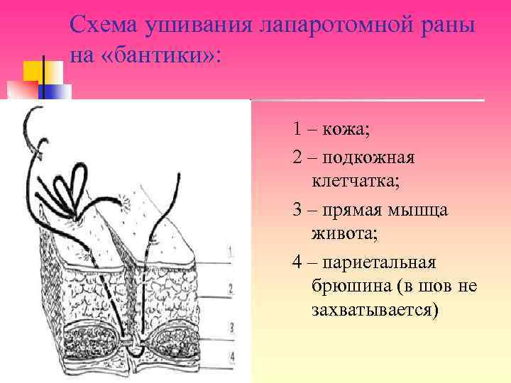 Схема ушивания лапаротомной раны на «бантики» : 1 – кожа; 2 – подкожная клетчатка;