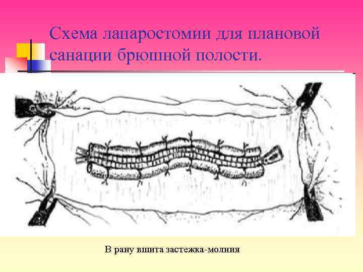 Схема лапаростомии для плановой санации брюшной полости. В рану вшита застежка-молния 