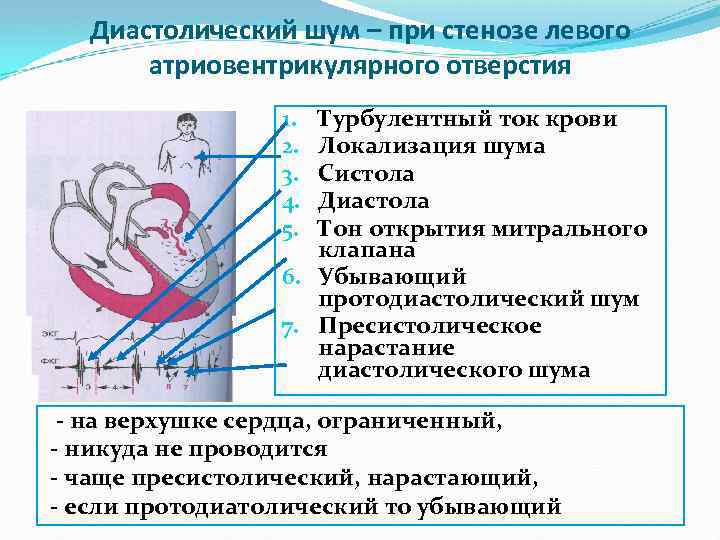 Диастолический шум – при стенозе левого атриовентрикулярного отверстия Турбулентный ток крови Локализация шума Систола