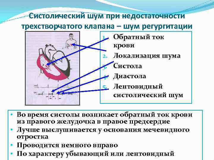 Шум на митральном клапане