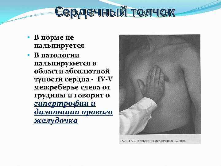 Сердечный толчок • В норме не пальпируется • В патологии пальпируюется в области абсолютной