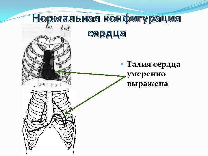 Талия сердца