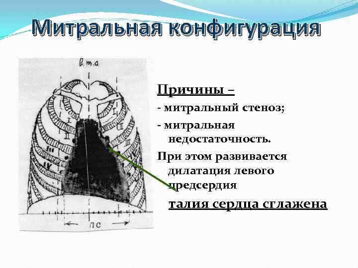 Митральное сердце. Митральная конфигурация сердца причины. Конфигурация сердца при митральном стенозе. Талия сердца при митральной конфигурации. Митральная конфигурация сердца наблюдается при.