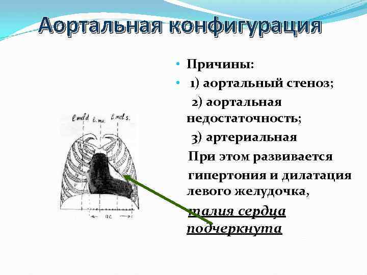 Аортальная конфигурация • Причины: • 1) аортальный стеноз; 2) аортальная недостаточность; 3) артериальная При