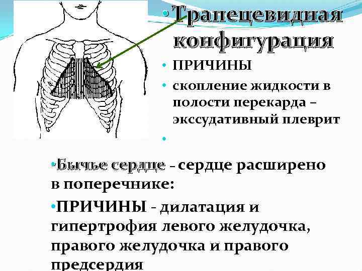  • Трапецевидная конфигурация • ПРИЧИНЫ • скопление жидкости в полости перекарда – экссудативный