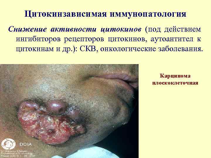 Цитокинзависимая иммунопатология Снижение активности цитокинов (под действием ингибиторов рецепторов цитокинов, аутоантител к цитокинам и