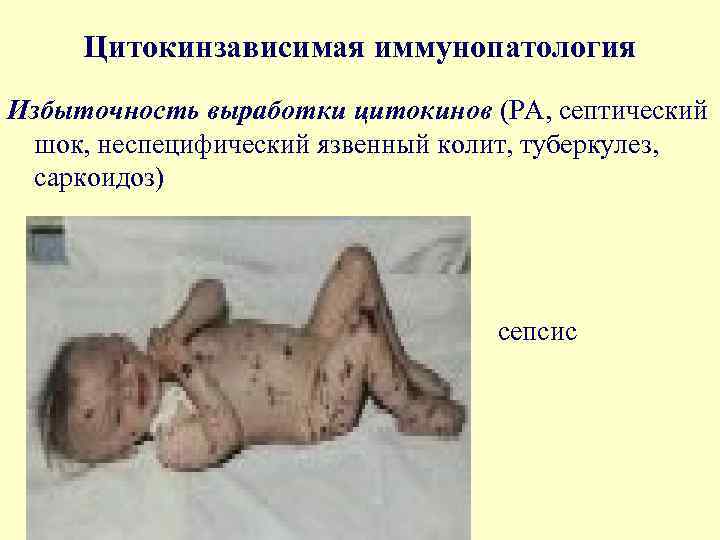 Цитокинзависимая иммунопатология Избыточность выработки цитокинов (РА, септический шок, неспецифический язвенный колит, туберкулез, саркоидоз) сепсис