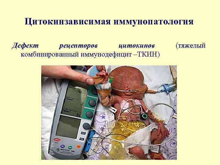 Цитокинзависимая иммунопатология Дефект рецепторов цитокинов комбинированный иммунодефицит –ТКИН) (тяжелый 