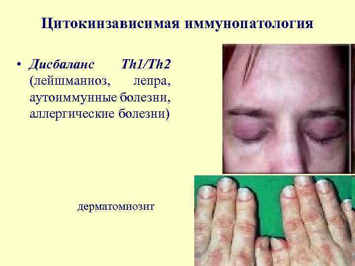 Цитокинзависимая иммунопатология • Дисбаланс Th 1/Th 2 (лейшманиоз, лепра, аутоиммунные болезни, аллергические болезни) дерматомиозит