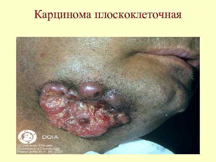 Карцинома плоскоклеточная 