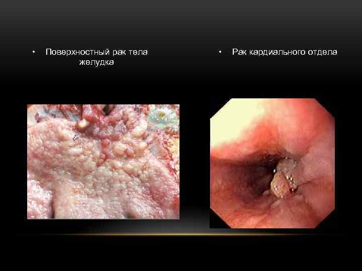  • Поверхностный рак тела желудка • Рак кардиального отдела 