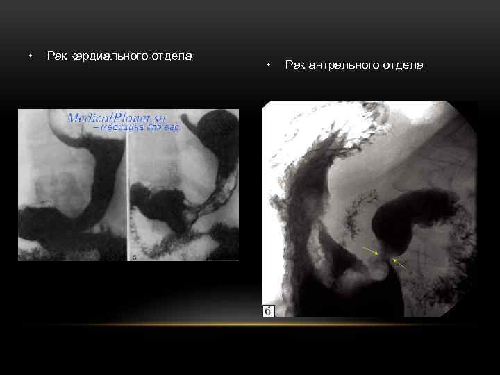  • Рак кардиального отдела • Рак антрального отдела 