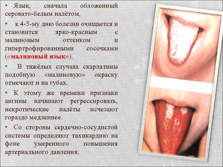  • Язык, сначала обложенный серовато-белым налётом, • к 4 -5 -му дню болезни