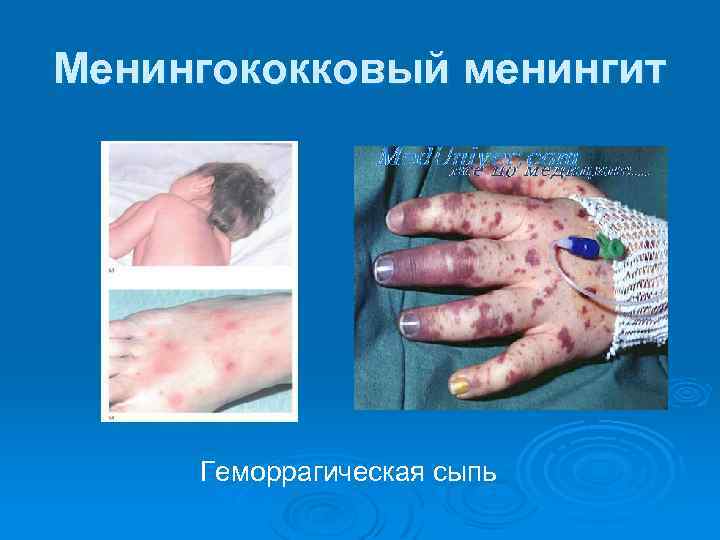 Менингококковый менингит Геморрагическая сыпь 