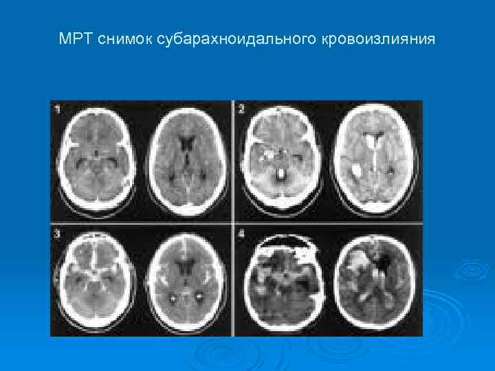 МРТ снимок субарахноидального кровоизлияния 