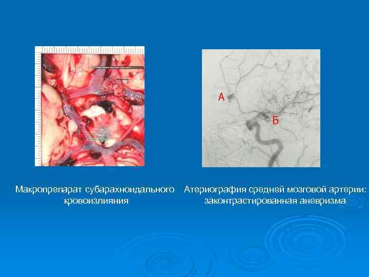 Макропрепарат субарахноидального кровоизлияния Атериография средней мозговой артерии: законтрастированная аневризма 