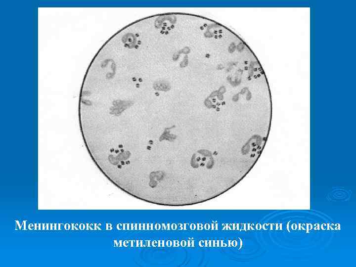 Менингококк в спинномозговой жидкости (окраска метиленовой синью) 