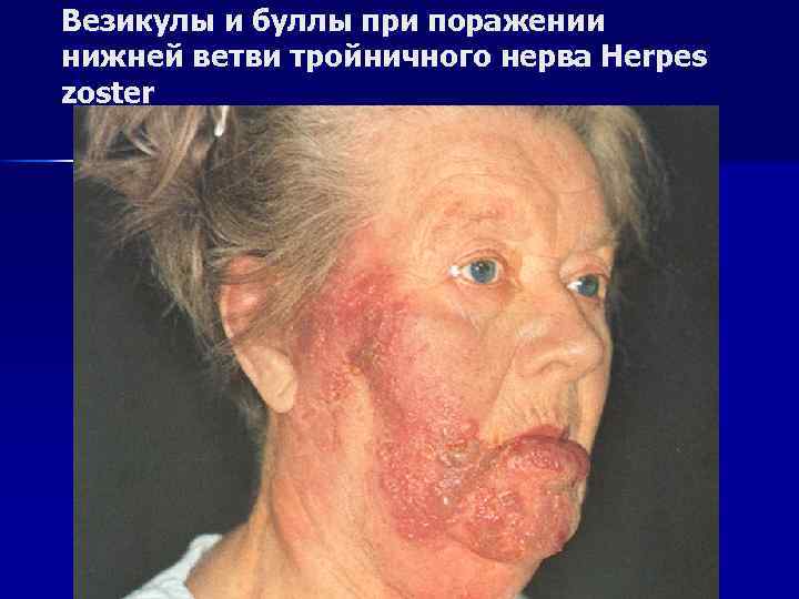 Везикулы и буллы при поражении нижней ветви тройничного нерва Herpes zoster 