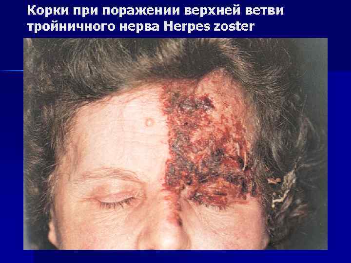 Корки при поражении верхней ветви тройничного нерва Herpes zoster 