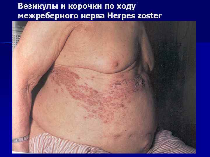 Везикулы и корочки по ходу межреберного нерва Herpes zoster 