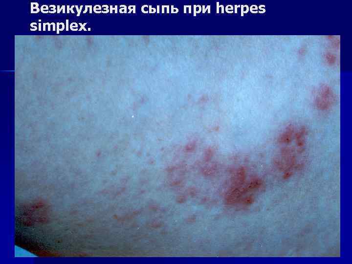 Везикулезная сыпь при herpes simplex. 