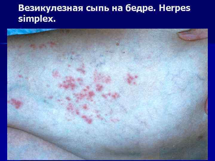 Везикулезная сыпь на бедре. Herpes simplex. 