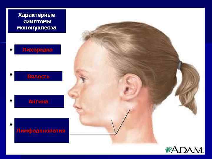 Характерные симптомы мононуклеоза Лихорадка Вялость Ангина Лимфаденопатия 