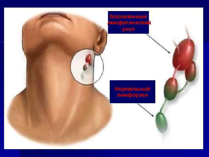 Воспаленный лимфатический узел Нормальный лимфоузел 