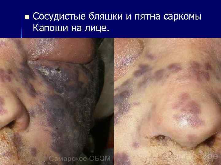 n Сосудистые бляшки и пятна саркомы Капоши на лице. 