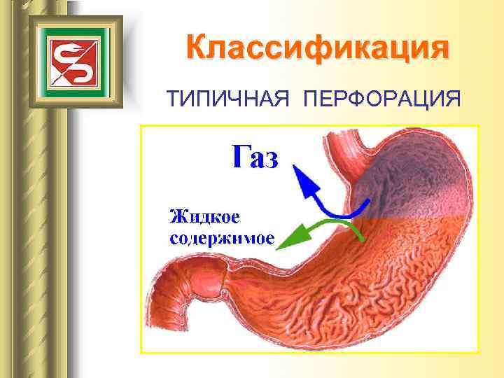Классификация ТИПИЧНАЯ ПЕРФОРАЦИЯ 