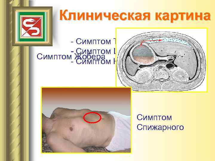 Клиническая картина - Симптом Тренделенбурга - Симптом Щеткина-Блюмберга Симптом Жобера - Симптом Юдина-Якушева Симптом