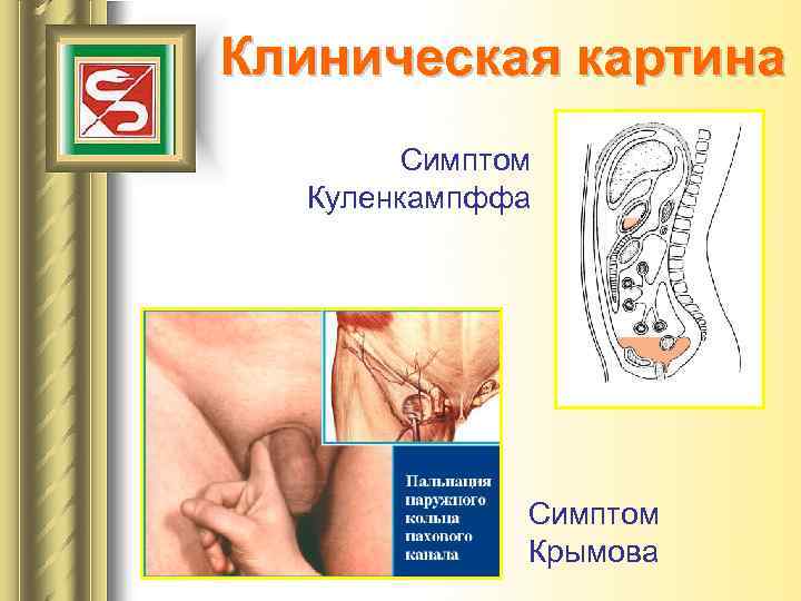 Клиническая картина Симптом Куленкампффа Симптом Крымова 