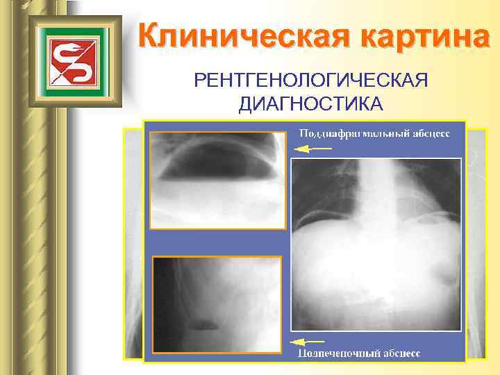 Клиническая картина РЕНТГЕНОЛОГИЧЕСКАЯ ДИАГНОСТИКА 