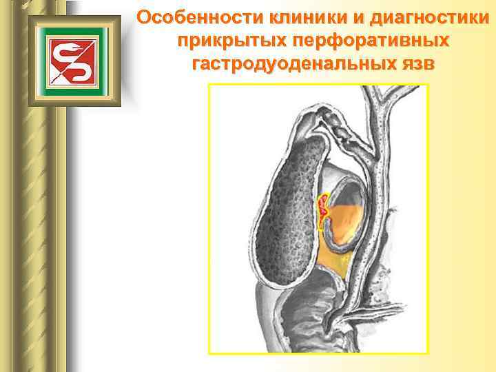 Особенности клиники и диагностики прикрытых перфоративных гастродуоденальных язв 