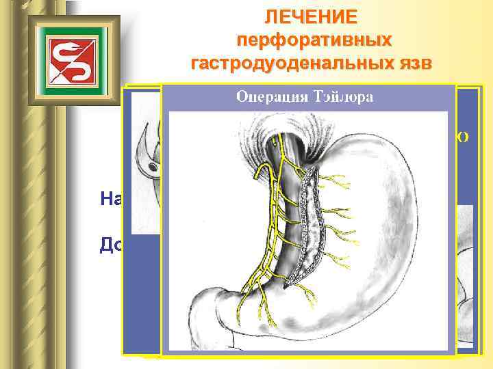 ЛЕЧЕНИЕ перфоративных гастродуоденальных язв Хирургическое лечение Наркоз – эндотрахеальный с ИВЛ. Доступ – верхняя