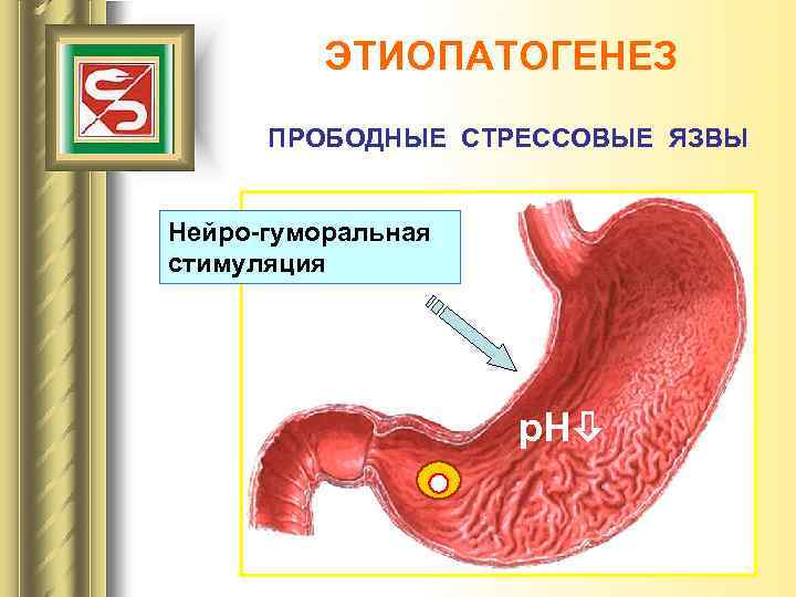 ЭТИОПАТОГЕНЕЗ ПРОБОДНЫЕ СТРЕССОВЫЕ ЯЗВЫ Нейро-гуморальная стимуляция р. Н 