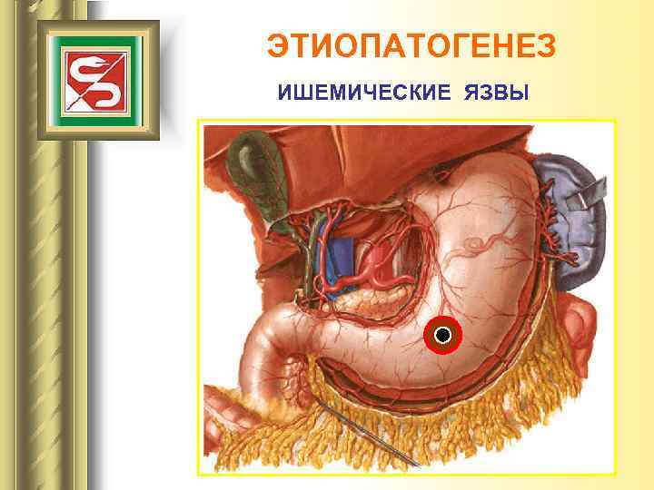 ЭТИОПАТОГЕНЕЗ ИШЕМИЧЕСКИЕ ЯЗВЫ 