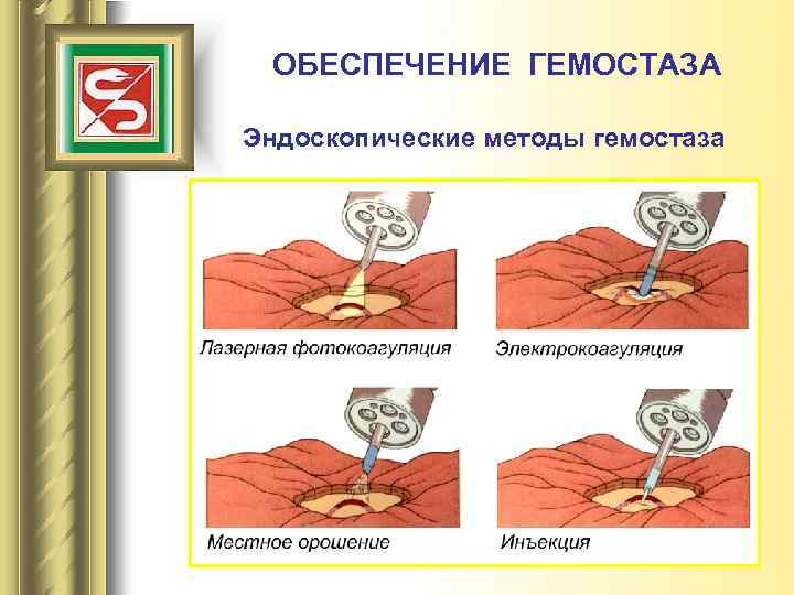 ОБЕСПЕЧЕНИЕ ГЕМОСТАЗА Эндоскопические методы гемостаза 
