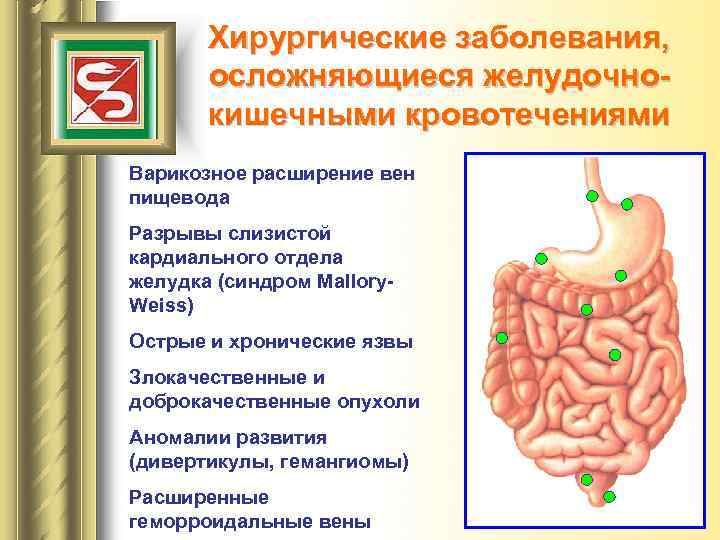 Хирургические заболевания, осложняющиеся желудочнокишечными кровотечениями Варикозное расширение вен пищевода Разрывы слизистой кардиального отдела желудка
