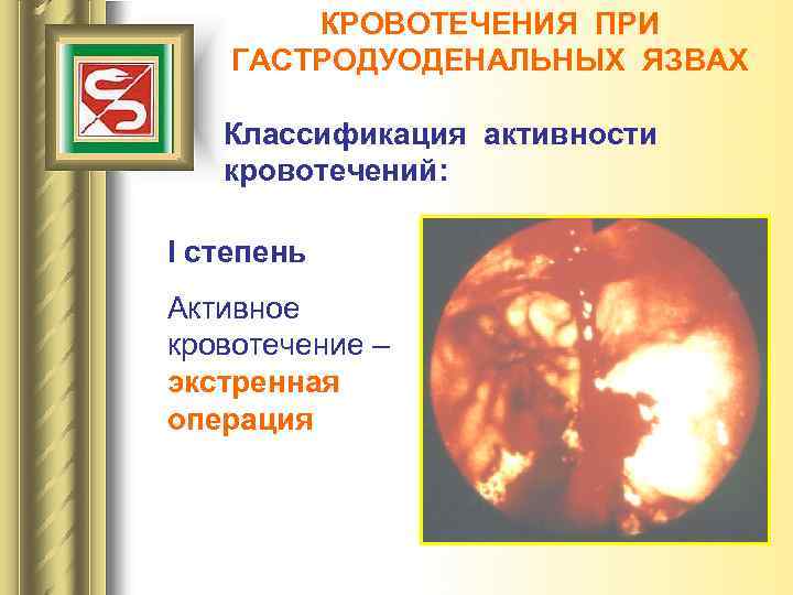 КРОВОТЕЧЕНИЯ ПРИ ГАСТРОДУОДЕНАЛЬНЫХ ЯЗВАХ Классификация активности кровотечений: I степень Активное кровотечение – экстренная операция