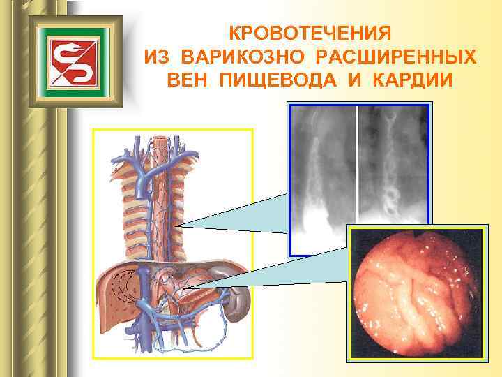 КРОВОТЕЧЕНИЯ ИЗ ВАРИКОЗНО РАСШИРЕННЫХ ВЕН ПИЩЕВОДА И КАРДИИ 