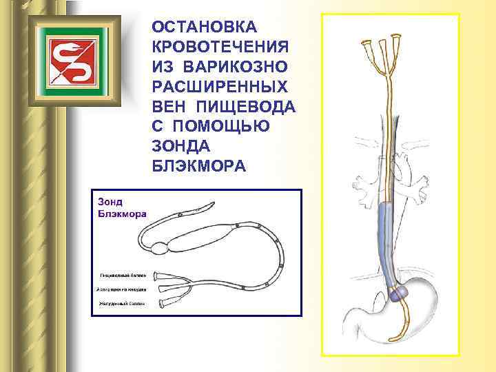 ОСТАНОВКА КРОВОТЕЧЕНИЯ ИЗ ВАРИКОЗНО РАСШИРЕННЫХ ВЕН ПИЩЕВОДА С ПОМОЩЬЮ ЗОНДА БЛЭКМОРА 
