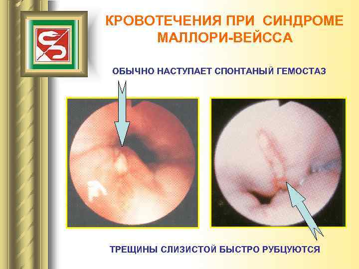 КРОВОТЕЧЕНИЯ ПРИ СИНДРОМЕ МАЛЛОРИ-ВЕЙССА ОБЫЧНО НАСТУПАЕТ СПОНТАНЫЙ ГЕМОСТАЗ ТРЕЩИНЫ СЛИЗИСТОЙ БЫСТРО РУБЦУЮТСЯ 